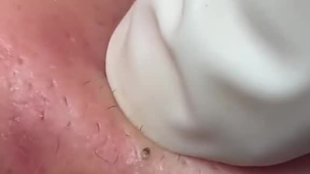 Blackheads & Milia, Big Cystic Acne Blackheads Extraction whiteheads Removal pimple Popping