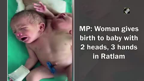 Woman Gives Birth To Baby With 2 Heads, 3 Hands In Madhya Pradesh's Ratlam