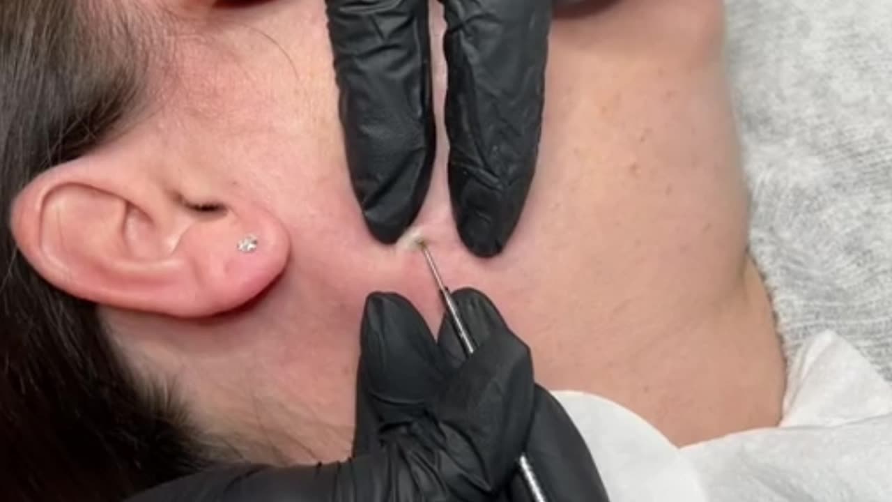 dr pimple popper blck extraction Popping huge blackheads and Pimple Popping - Best Pimple Popping