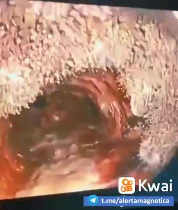 ENDOSCOPIA REVELA ÓXIDO DE GRAFENO DENTRO DO CORPO 💉☠