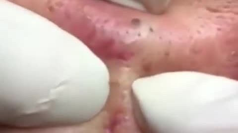 dr pimple popper,drpimplepopper,pimple popping,pimple,