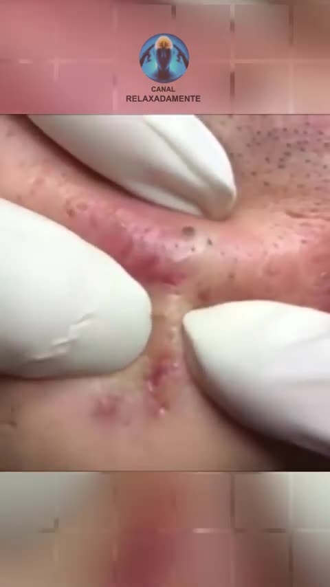 dr pimple popper,drpimplepopper,pimple popping,pimple,