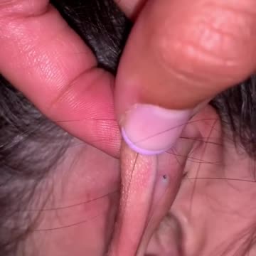#Short #Skincare #Blackheads #Extraction #Satisfying #Pimple __ Pimplebook