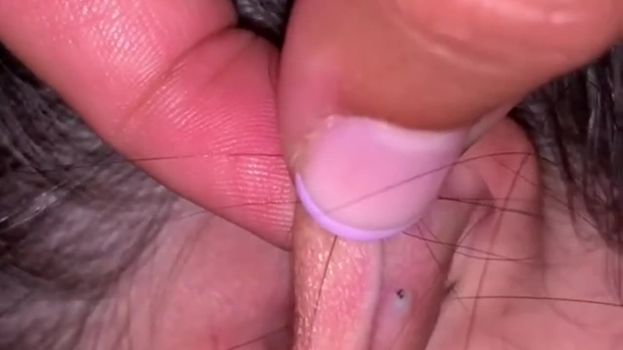 #Short #Skincare #Blackheads #Extraction #Satisfying #Pimple __ Pimplebook