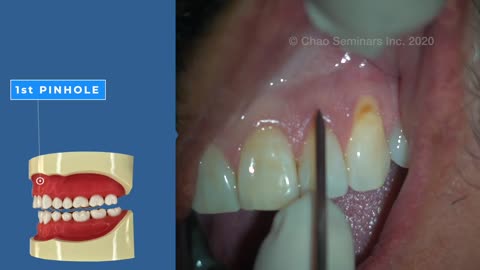 Pinhole Surgical Technique online course sizzle preview!