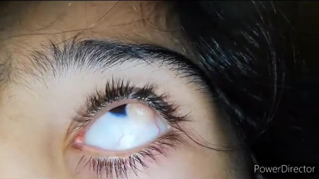 Eye