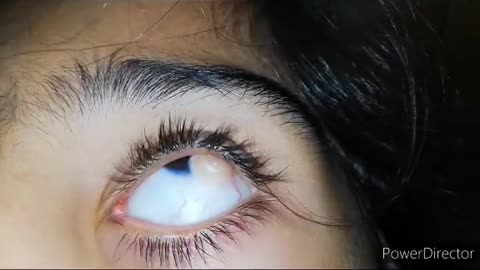 Eye