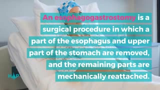 How To Treat Esophageal Cancer