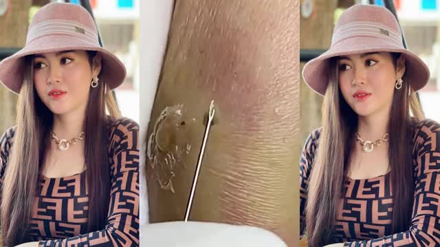cystic acne pop