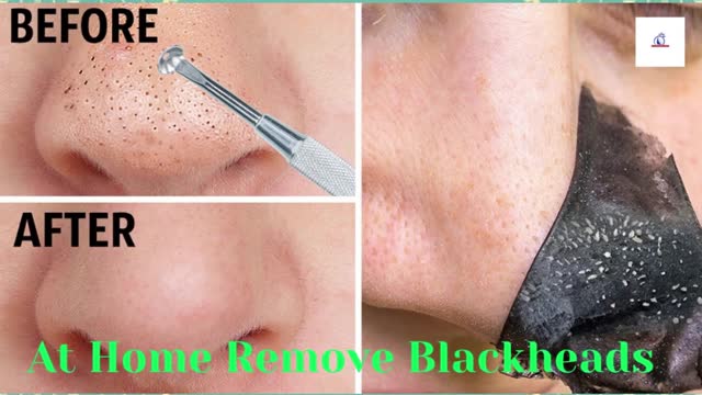 At Home Remove Blackheads | #Shorts1 | #Beauty_tech