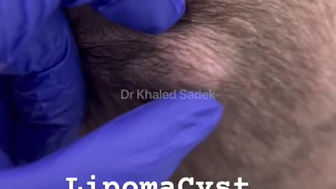 Scalp cyst #skincare #blackheadremoval