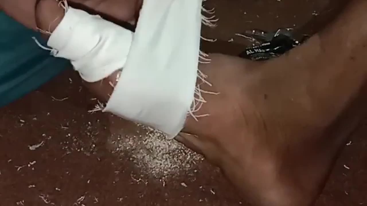 Fracture of the big toe