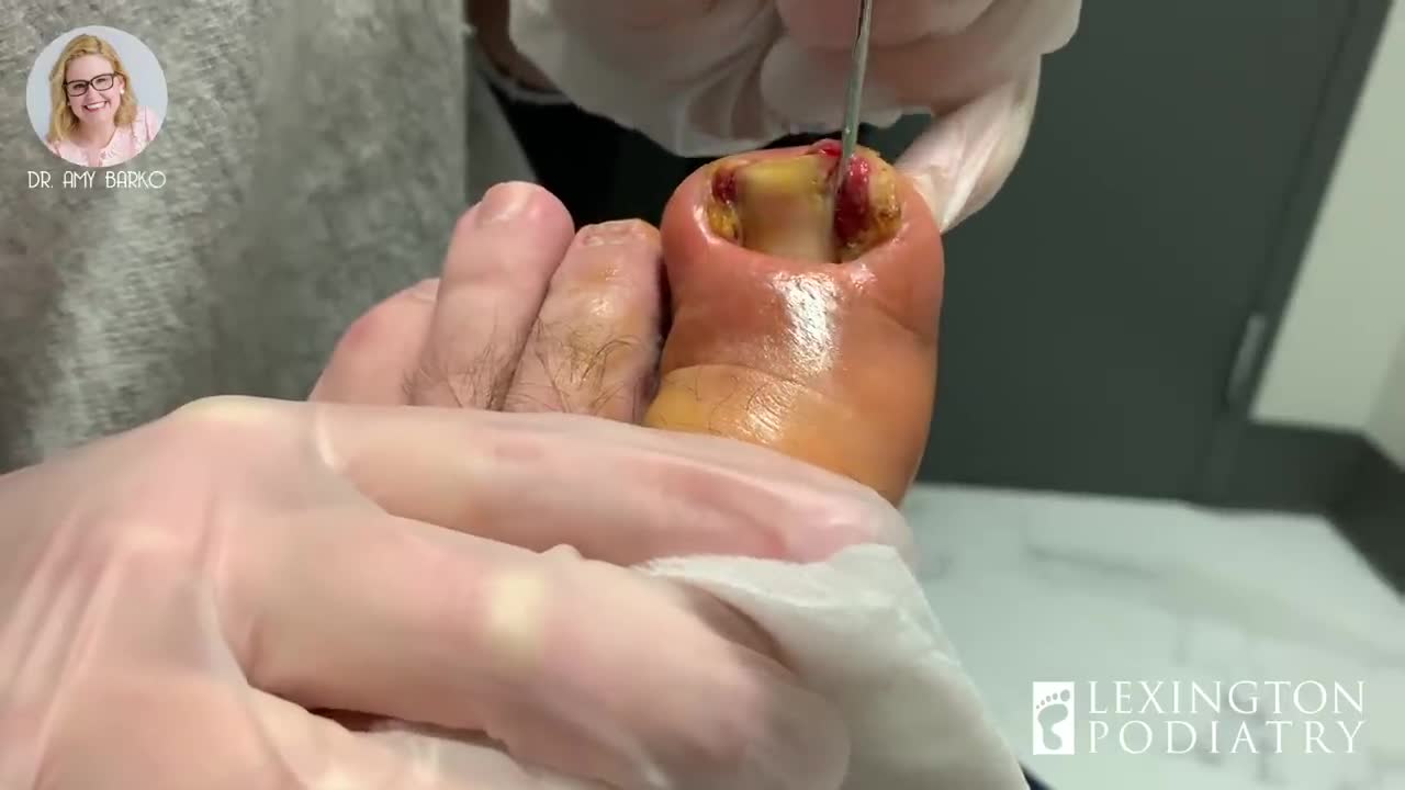 Epic Ingrown Toenail