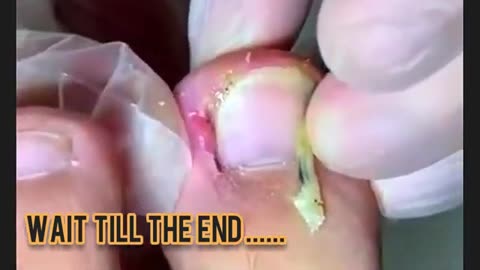 Asmr deep ingrown toenail removal