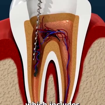 How Root canals work - Root Canal