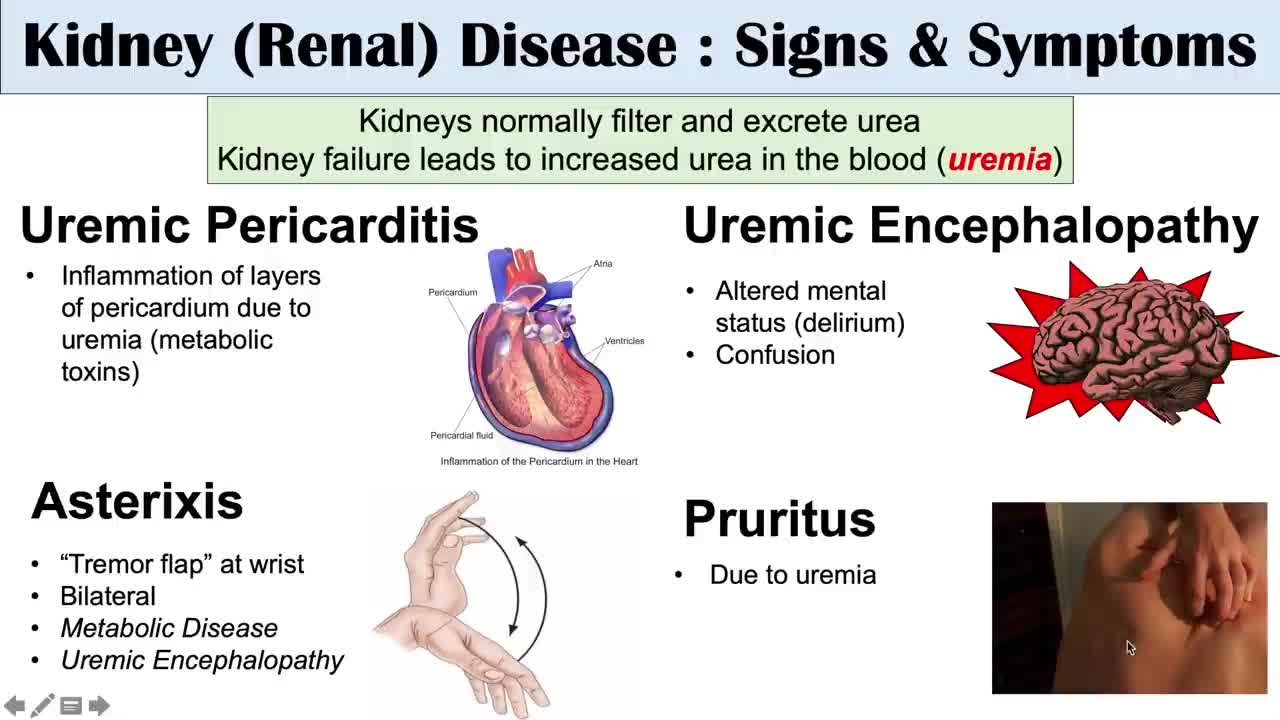 Kidney (Renal) Disease Signs