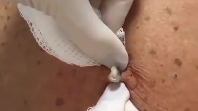 satisfying blackhead removal video