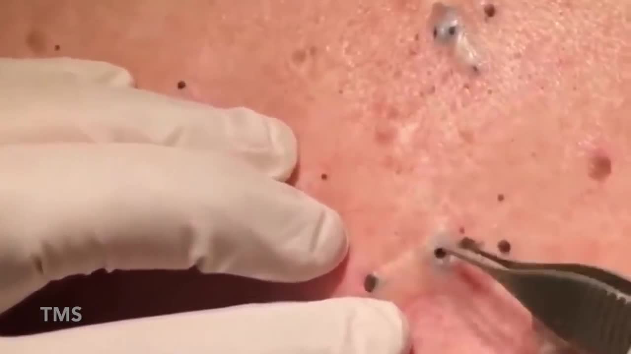 Back Cystic Acne Extraction Blackheads #1