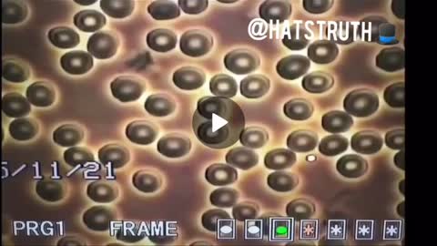 How mRNA vaccinated blood looks under a microscope.