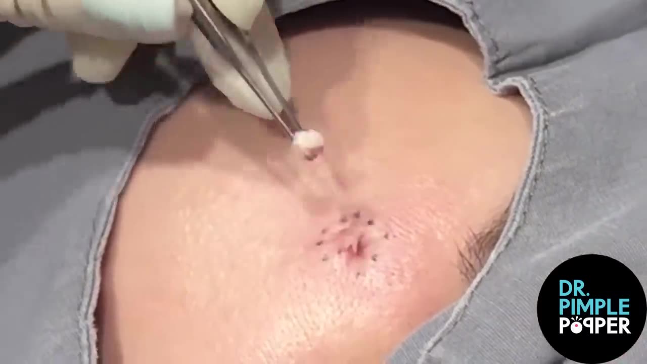 8 MINUTES OF SATISFYING POPS with Dr Sandra Lee - Dr Pimple Popper