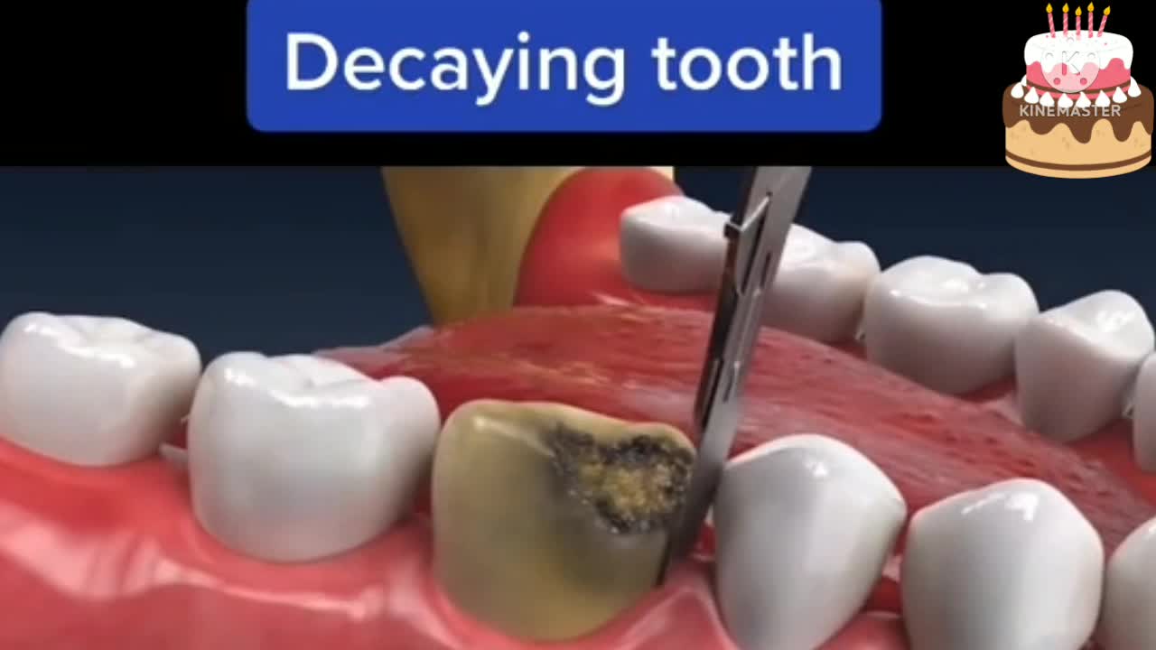 Decaying tooth.How things work.