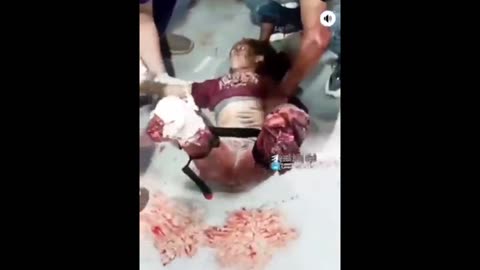 Brutality of israel's indiscriminate bombing in Gaza - a girl whose legs were cut off. *NSFW