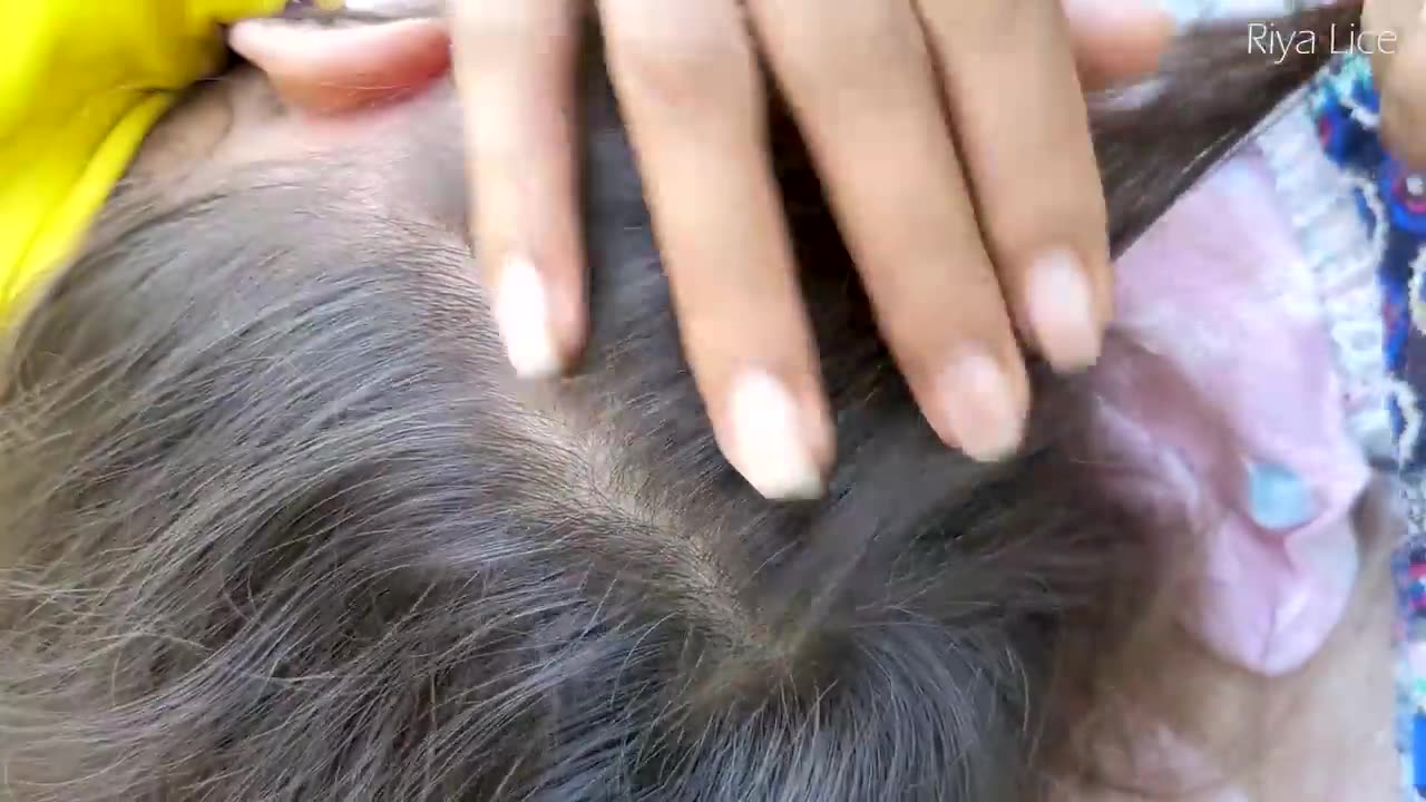 Remove many lice from brown hair ... plucking most of lice from head