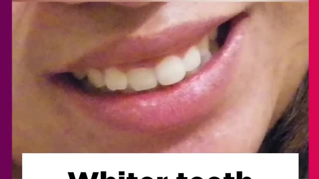 Cleaner Smile Teeth Whitening Kit , Make your smile attractive