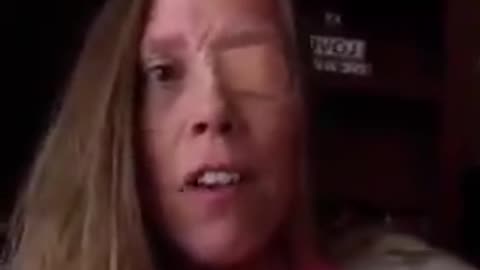7 months with Bell’s palsy from the jab & her drs are lying to her