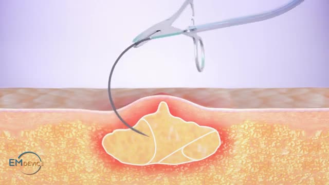 EM Device Lab - Quickloop™ abscess treatment device