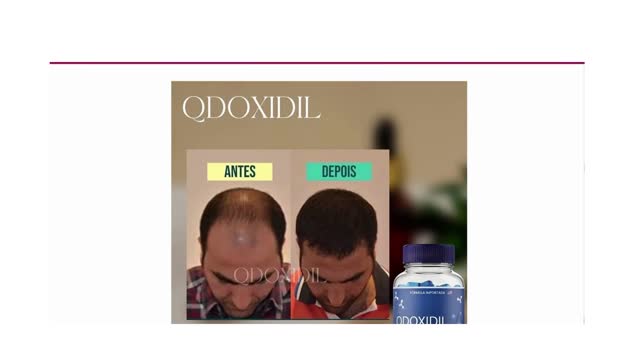 QDOXIDIL para queda de cabelo