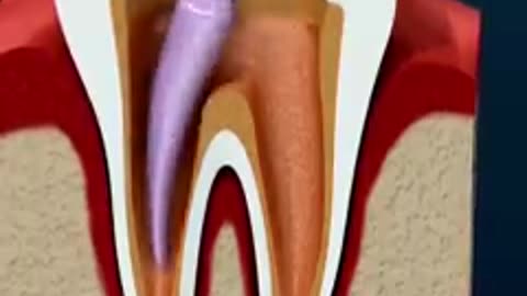 Root canal treatment