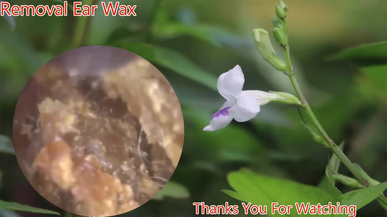 gigantic ear wax removal #6