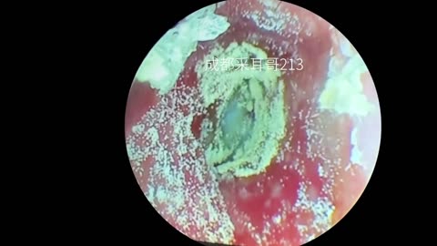 gigantic ear wax removal #43
