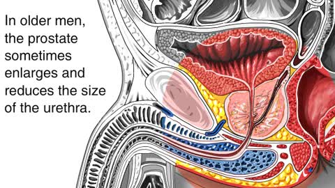 BPH gone… prostate shrunk… quick, easy and safe!
