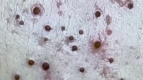 This What Your Remove Blackheads Should Popping