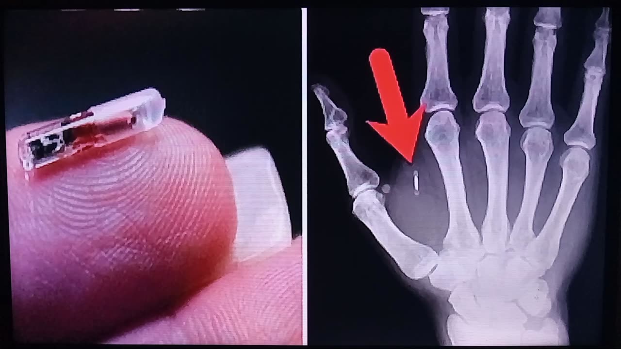 MOTB- MICROCHIP IMPLANT UPDATE- GMS GETTHISWORK2