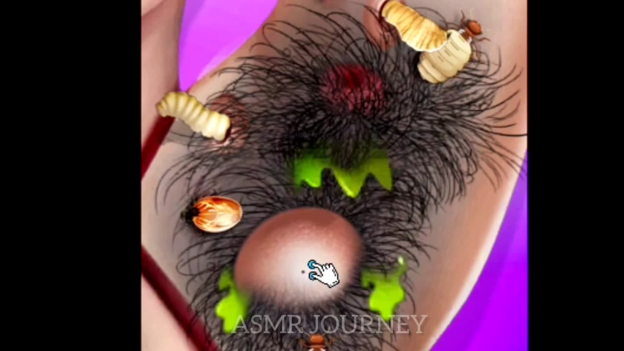 ASMR eye stone removal animation | Eyelid Sebum Extrusion Animation ||ASMR Remova oshi no ko| #asmr