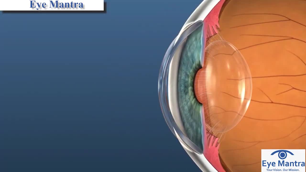 Lasik-Specs Removal surgery | Lasik surgery Procedure (Animation)