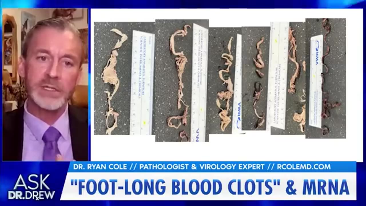 Dr. Ryan Cole, tells Dr. Drew about foot-long clots he's been finding in mRNA injected patients