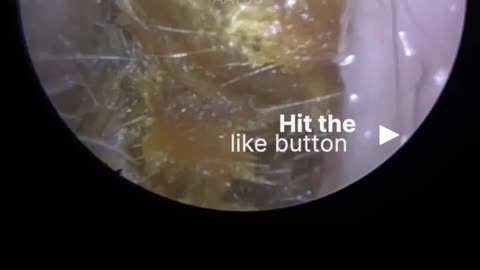 HARD EAR WAX & SKIN PLUG REMOVAL