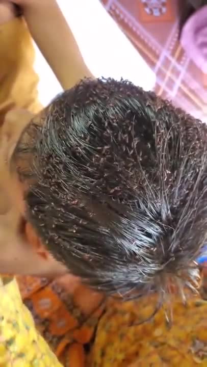 Lice Removing Treatment #short