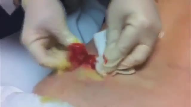 TOP 5 Mosr Disgusting Pimple/Cyst Popping Compilation