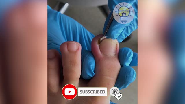 How to Clean Toenails - EP1