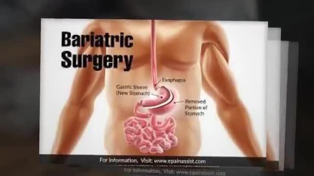 Bariatric Surgery