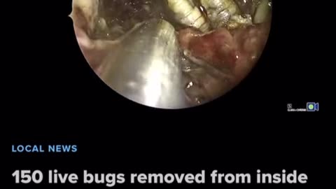 IN FLORIDA DOCTORS REMOVED 150 LIVE MAGGOTS FROM A MAN’S NOSE THAT WERE FEEDING ON HIS MUCOUS