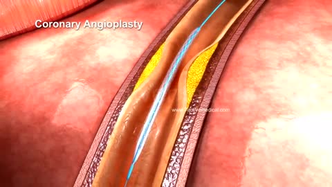 HEART ATTACK simulation