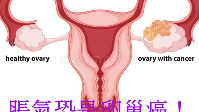 脹氣恐是卵巢癌! 5族群注意