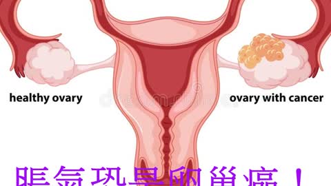 脹氣恐是卵巢癌！ 5族群注意