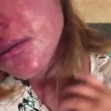 Graphic Warning: Adverse Side Effects Reported